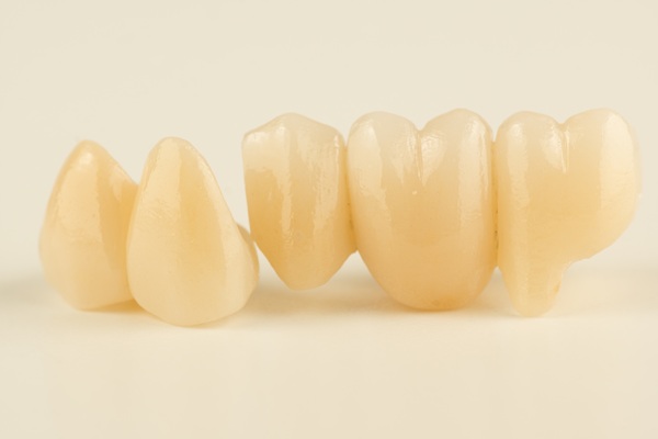 What Conditions Would Require Dental Bridges?